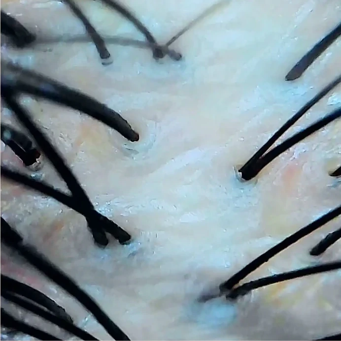 Magnified scalp surface after a single cleansing treatment