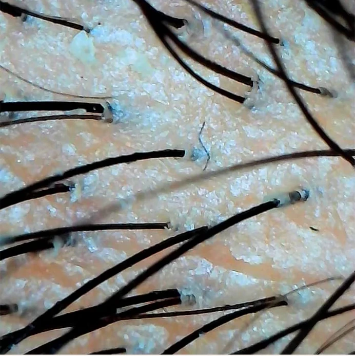 Magnified scalp surface before a single cleansing treatment